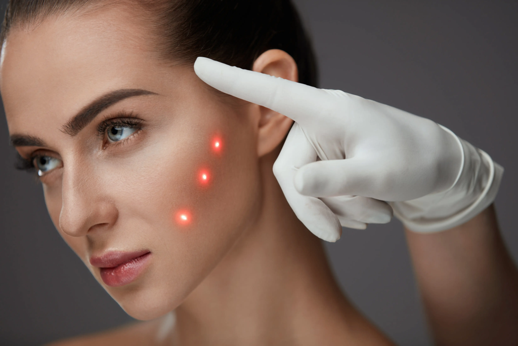 Laser for Hyperpigmentation: Complete Skin Guide